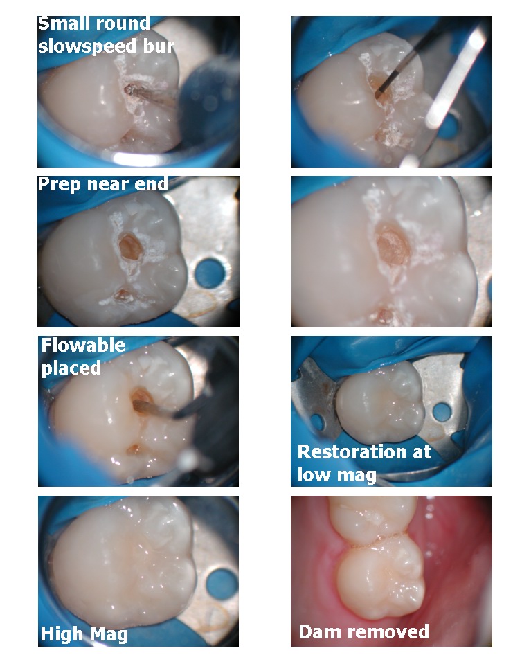 Caries Detector pt 2A.jpg